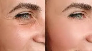 Ellansé y autoimagen: cuando la piel acompaña tu transformación